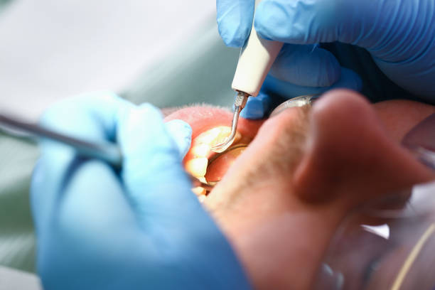 Best Emergency Dental Care for Broken or Chipped Teeth in North Tustin, CA